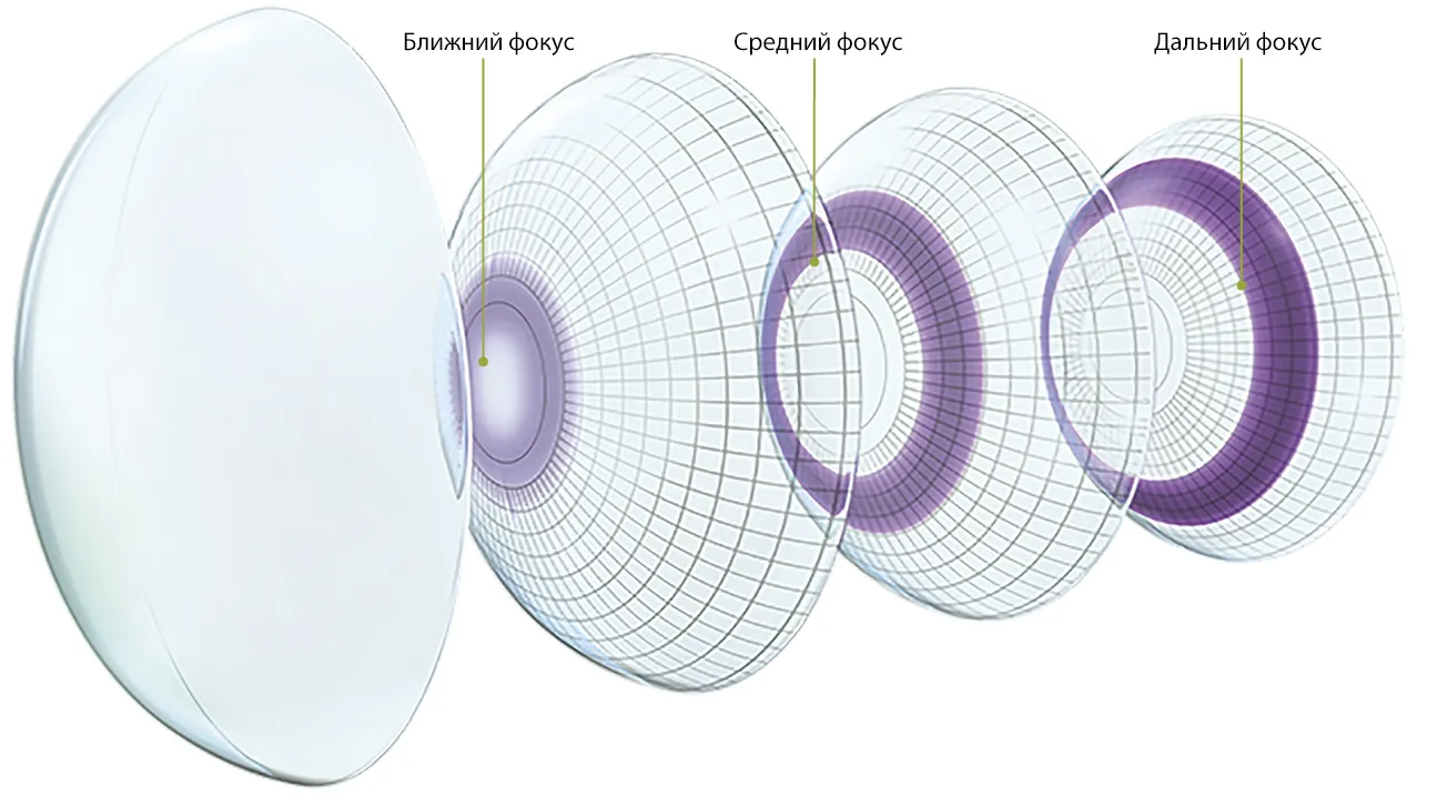 мультифокальные линзы